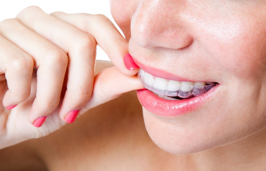 invisalign