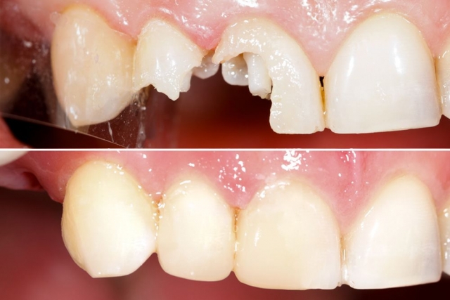 Inlays_Onlays_2