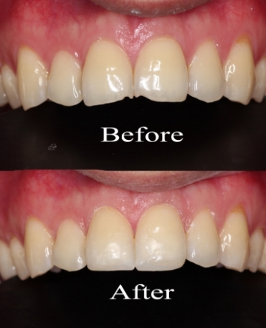 chipped+teeth